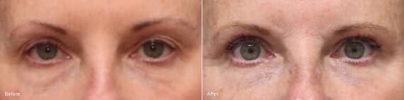 Upper Eyelid Surgery Before and After Photos in Princeton, NJ, Patient 8807