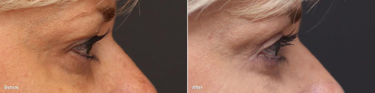 Upper Eyelid Surgery Before and After Photos in Princeton, NJ, Patient 8817