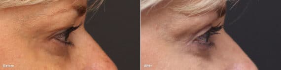 Upper Eyelid Surgery Before and After Photos in Princeton, NJ, Patient 8817