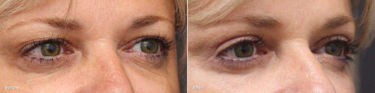 Upper Eyelid Surgery Before and After Photos in Princeton, NJ, Patient 8817