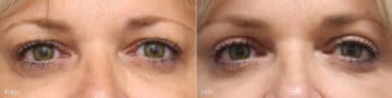 Upper Eyelid Surgery Before and After Photos in Princeton, NJ, Patient 8817