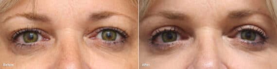 Upper Eyelid Surgery Before and After Photos in Princeton, NJ, Patient 8817