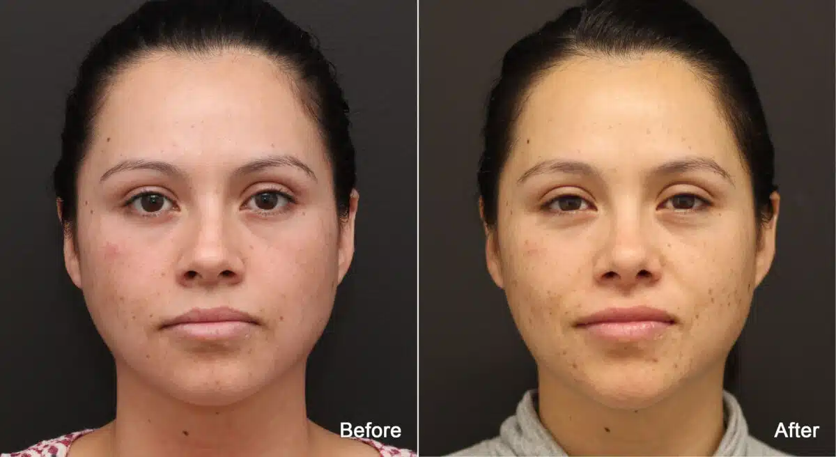 Rhinoplasty Before and After Photos in Princeton, NJ, Patient 8827