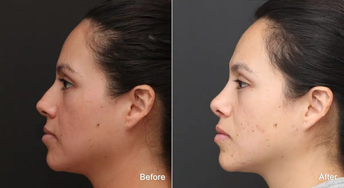 Rhinoplasty Before and After Photos in Princeton, NJ, Patient 8827