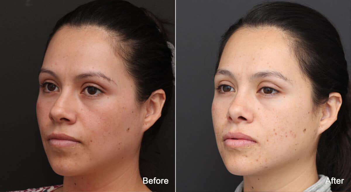 Rhinoplasty Before and After Photos in Princeton, NJ, Patient 8827