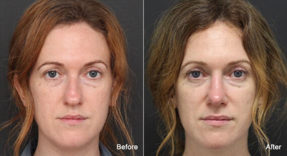 Rhinoplasty Before and After Photos in Princeton, NJ, Patient 8837