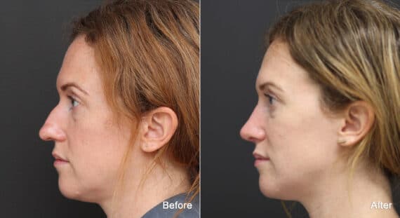 Rhinoplasty Before and After Photos in Princeton, NJ, Patient 8837