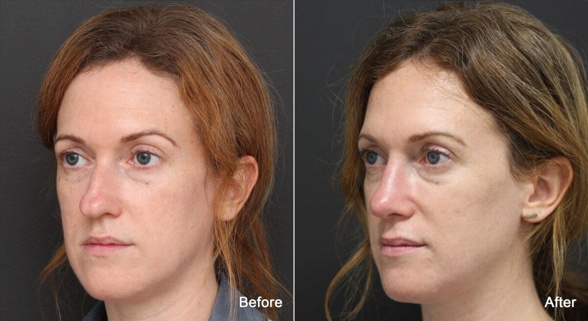 Rhinoplasty Before and After Photos in Princeton, NJ, Patient 8837