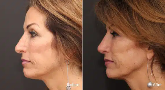 Rhinoplasty Before and After Photos in Princeton, NJ, Patient 8877