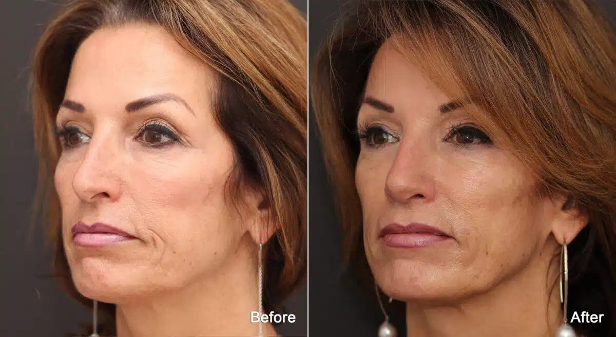 Rhinoplasty Before and After Photos in Princeton, NJ, Patient 8877
