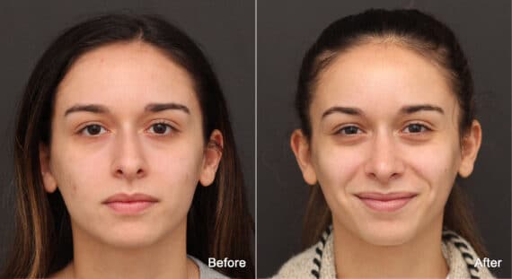 Rhinoplasty Before and After Photos in Princeton, NJ, Patient 8905