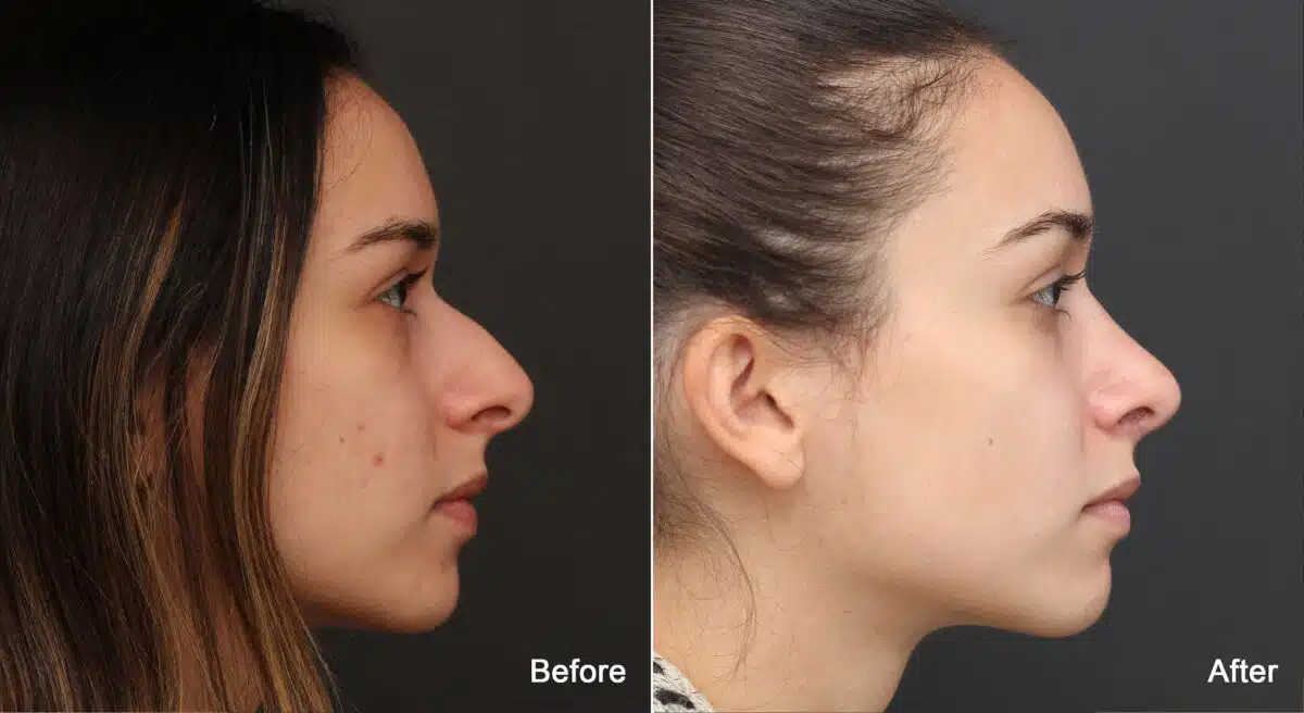 Rhinoplasty Before and After Photos in Princeton, NJ, Patient 8905