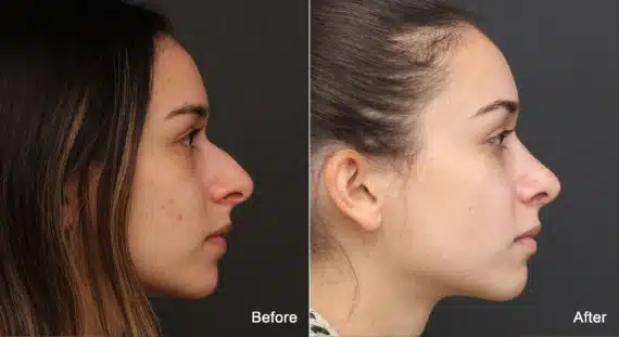 Rhinoplasty Before and After Photos in Princeton, NJ, Patient 8905