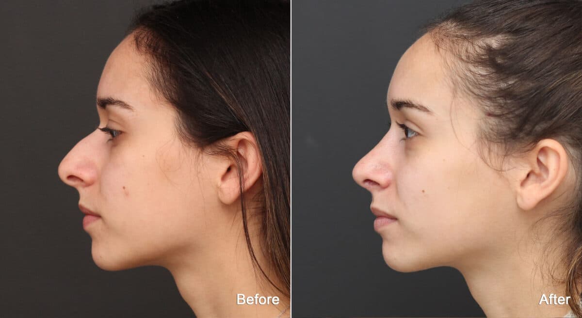 Rhinoplasty Before and After Photos in Princeton, NJ, Patient 8905