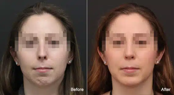 Rhinoplasty Before and After Photos in Princeton, NJ, Patient 8941