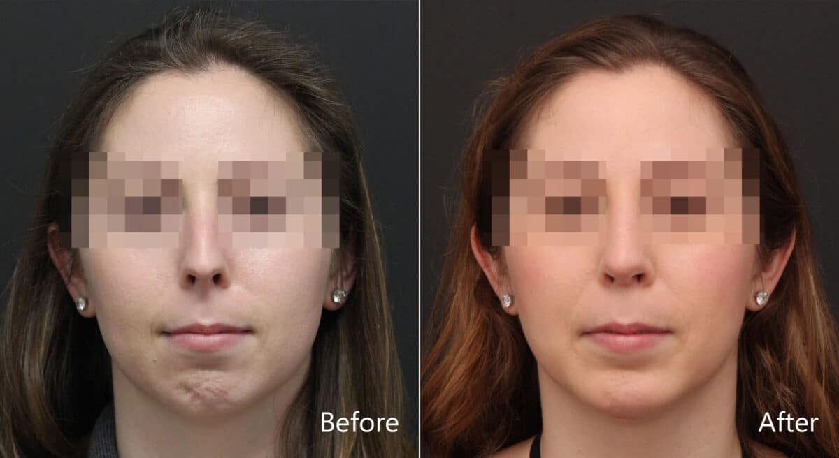 Chin Implants Before and After Photos in Princeton, NJ, Patient 8955