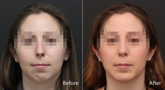 Chin Implants Before and After Photos in Princeton, NJ, Patient 8955
