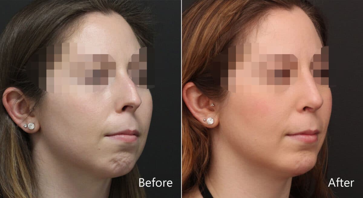 Chin Implants Before and After Photos in Princeton, NJ, Patient 8955