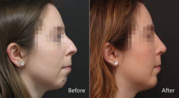 Chin Implants Before and After Photos in Princeton, NJ, Patient 8955