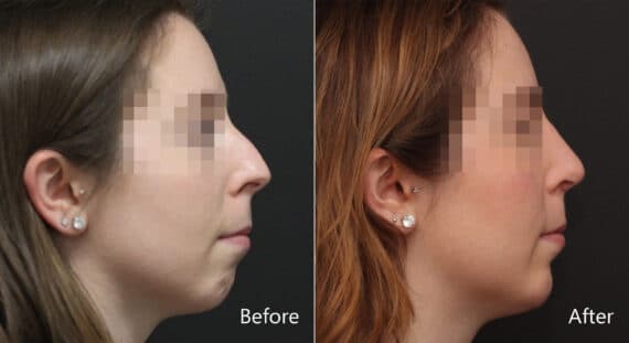 Chin Implants Before and After Photos in Princeton, NJ, Patient 8955