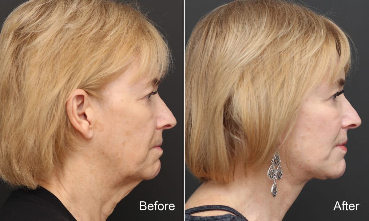 Facelift Before and After Photos in Princeton, NJ, Patient 9057