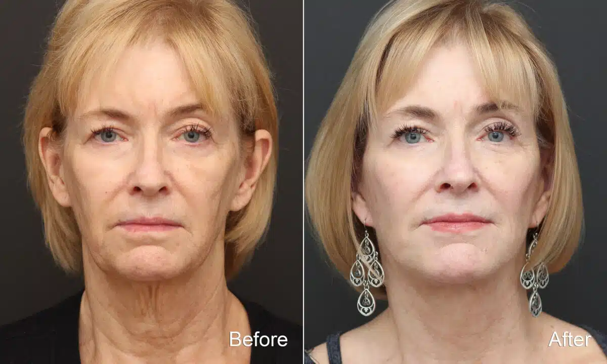 Facelift Before and After Photos in Princeton, NJ, Patient 9057