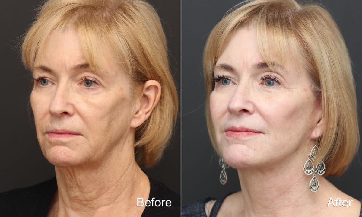 Facelift Before and After Photos in Princeton, NJ, Patient 9057