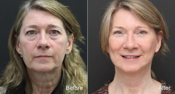 Facelift Before and After Photos in Princeton, NJ, Patient 9068