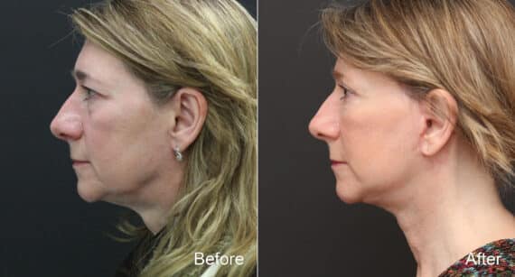 Facelift Before and After Photos in Princeton, NJ, Patient 9068