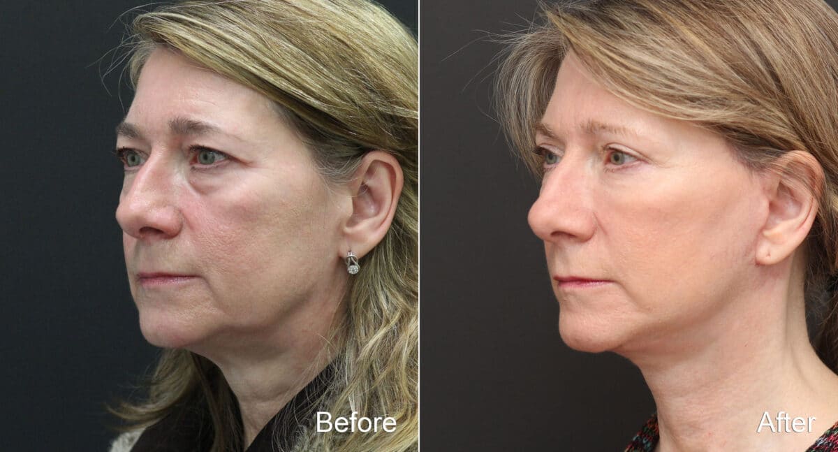 Facelift Before and After Photos in Princeton, NJ, Patient 9068