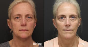 Facelift Before and After Photos in Princeton, NJ, Patient 9072