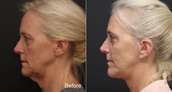Facelift Before and After Photos in Princeton, NJ, Patient 9072