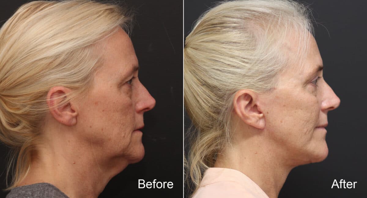 Facelift Before and After Photos in Princeton, NJ, Patient 9072