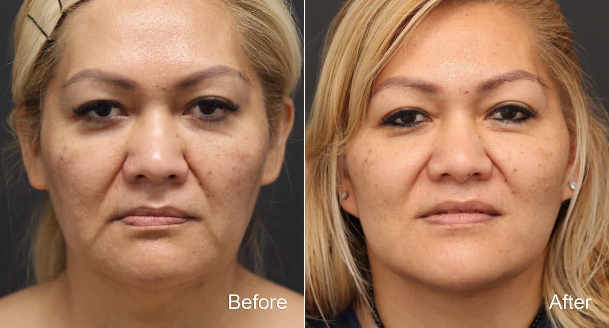 Facelift Before and After Photos in Princeton, NJ, Patient 9076