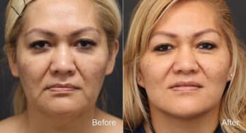 Facelift Before and After Photos in Princeton, NJ, Patient 9076