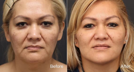 Facelift Before and After Photos in Princeton, NJ, Patient 9076