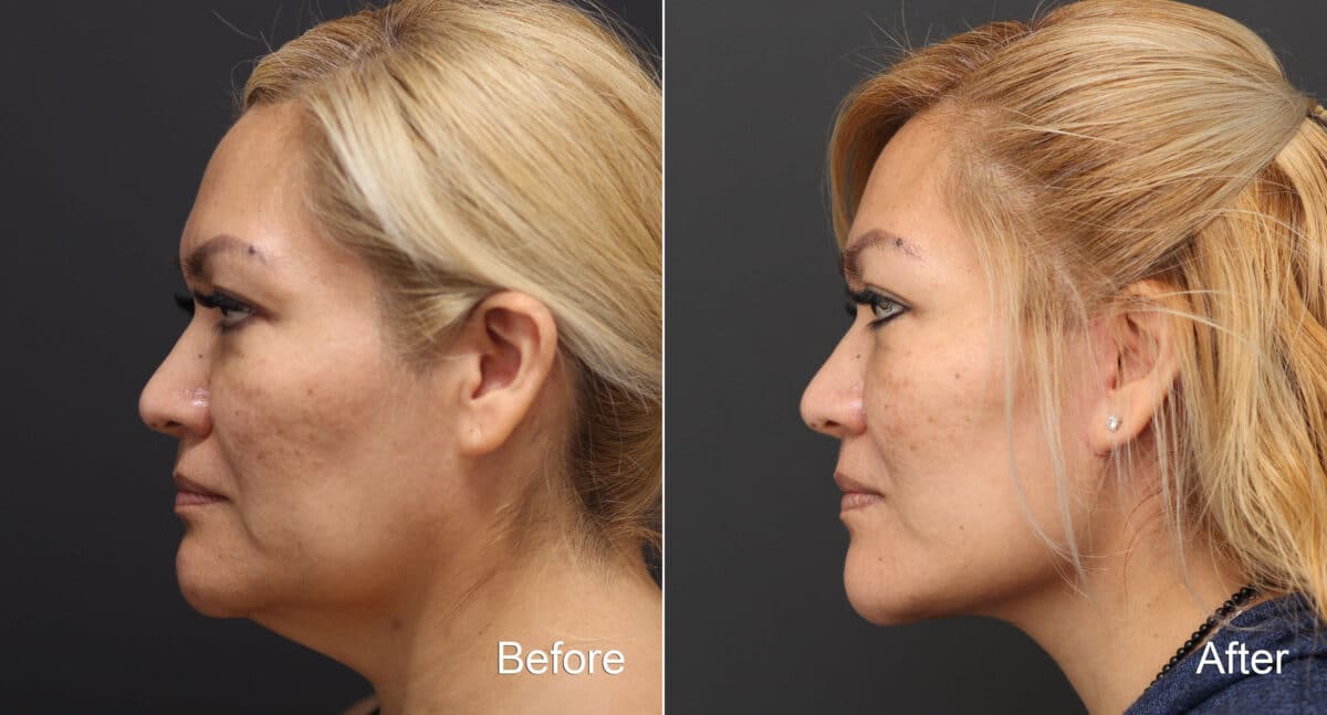 Facelift Before and After Photos in Princeton, NJ, Patient 9076