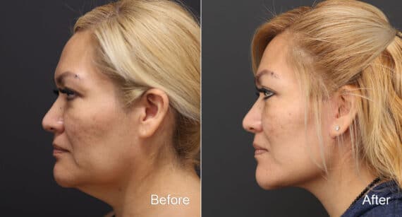 Facelift Before and After Photos in Princeton, NJ, Patient 9076
