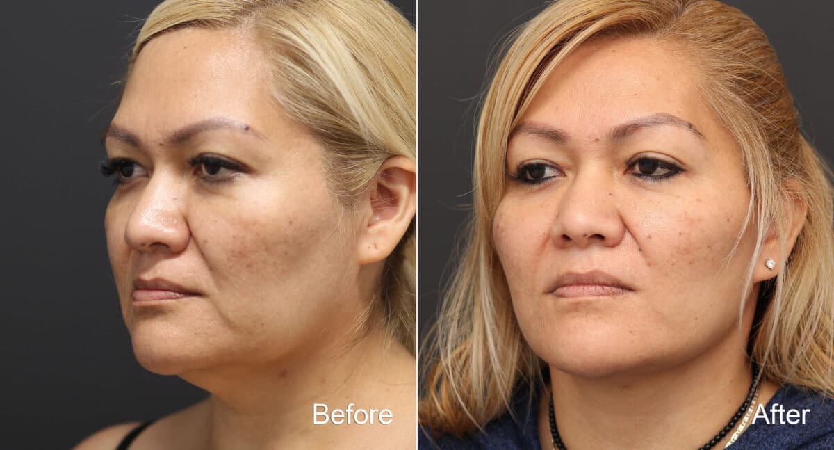 Facelift Before and After Photos in Princeton, NJ, Patient 9076