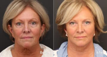 Facelift Before and After Photos in Princeton, NJ, Patient 9080