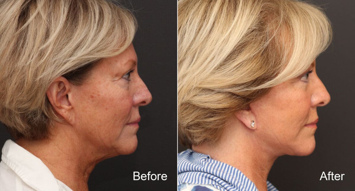 Facelift Before and After Photos in Princeton, NJ, Patient 9080