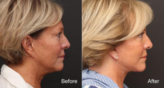 Facelift Before and After Photos in Princeton, NJ, Patient 9080