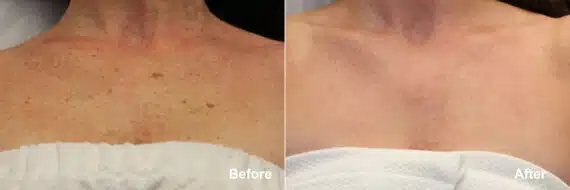 Laser Treatments Before and After Photos in Princeton, NJ, Patient 9128