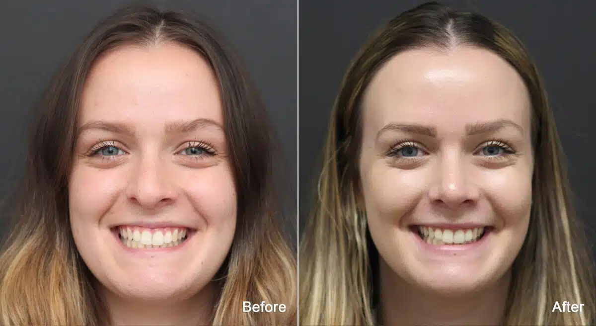 Rhinoplasty Before and After Photos in Princeton, NJ, Patient 9132