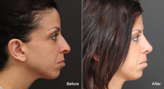 Rhinoplasty Before and After Photos in Princeton, NJ, Patient 9139