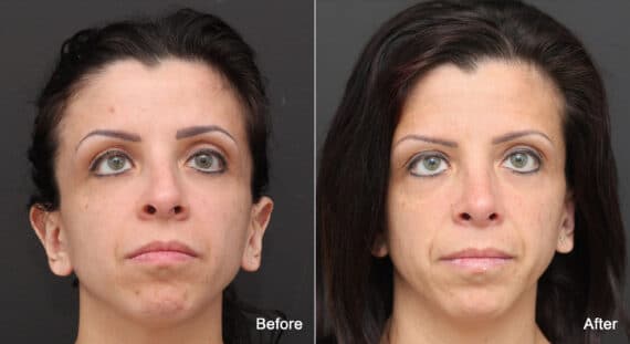 Rhinoplasty Before and After Photos in Princeton, NJ, Patient 9139