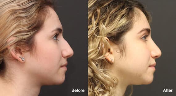 Rhinoplasty Before and After Photos in Princeton, NJ, Patient 9160