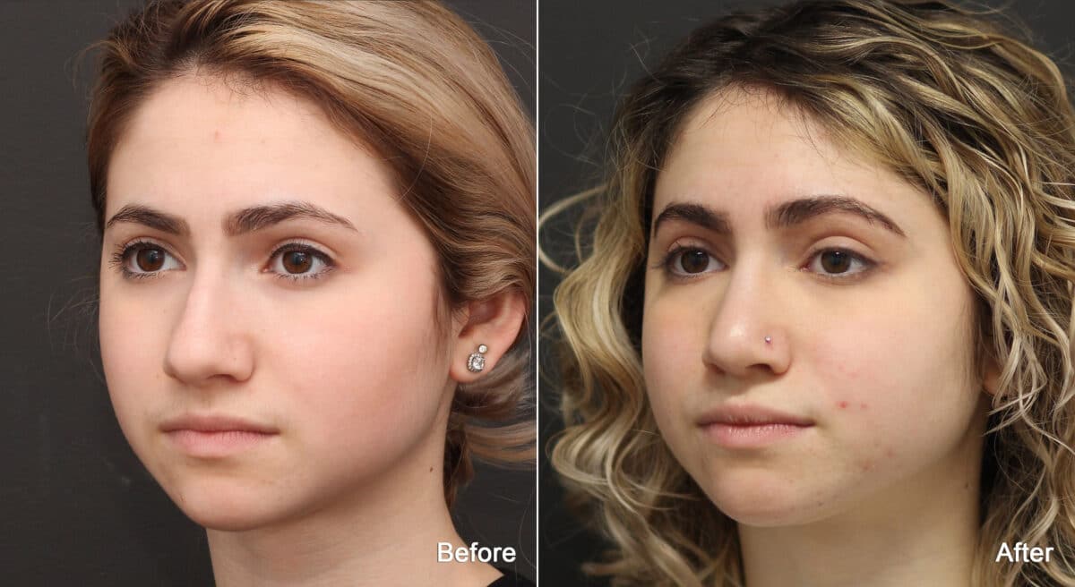 Rhinoplasty Before and After Photos in Princeton, NJ, Patient 9160