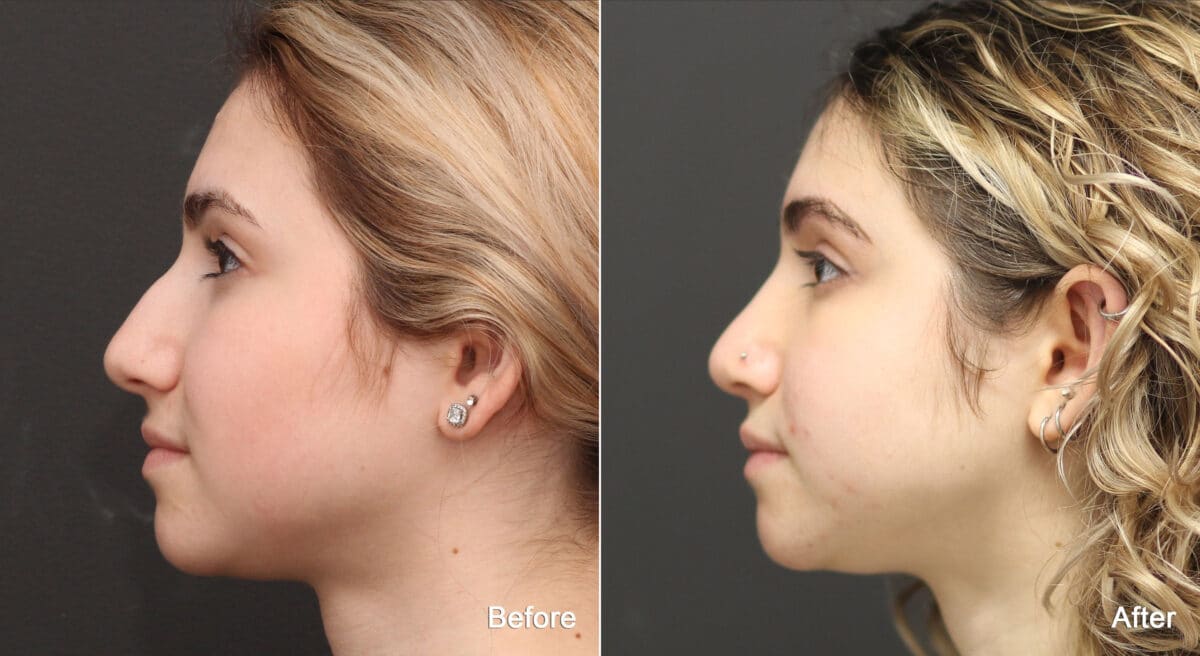 Rhinoplasty Before and After Photos in Princeton, NJ, Patient 9160