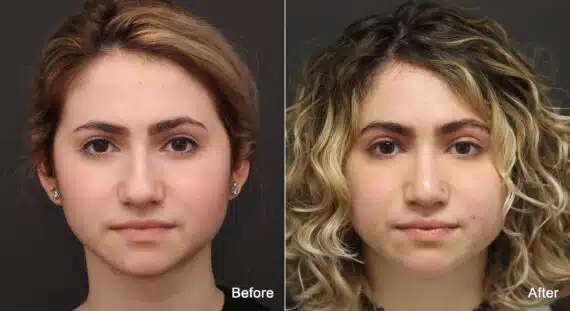 Rhinoplasty Before and After Photos in Princeton, NJ, Patient 9160